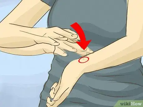 Image titled Stop Scratching a Mosquito Bite Step 2