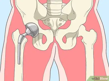 Image titled Treat Hip Arthritis Step 16