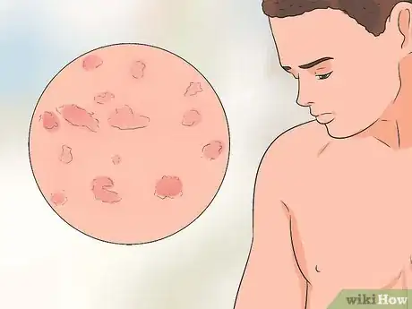 Image titled Treat Itchy Breasts Step 19