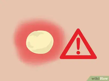 Image titled Stop Gnat Bites from Itching Step 10