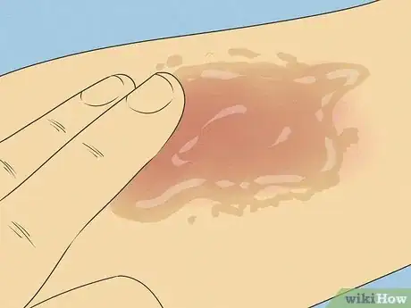 Image titled Improve Eczema with Diet Step 3
