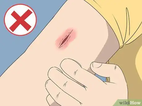 Image titled Know if a Wound Is Healing Step 13