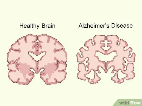 Image titled Treat Neurological Disorders Step 7