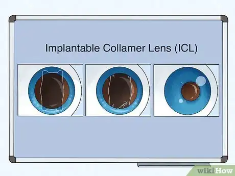 Image titled Know if Laser Vision Surgery Is Right for You Step 11