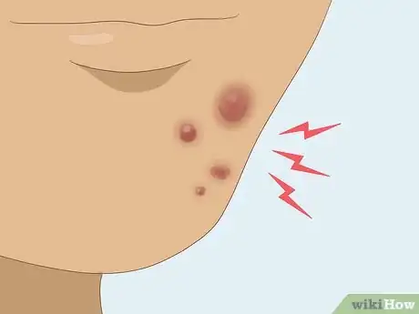 Image titled Prevent Cystic Acne Step 7