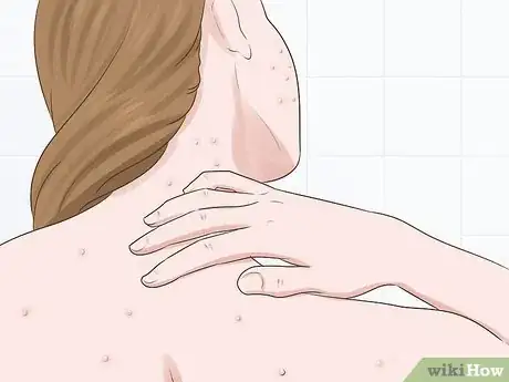 Image titled Know if You Need a Prescription Acne Treatment Step 5