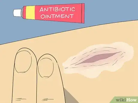 Image titled Know if a Wound Is Healing Step 11