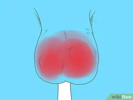 Image titled Know if You Have Epididymitis Step 2