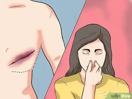 Image titled Know when to Call the Doctor After Mastectomy Surgery Step 11