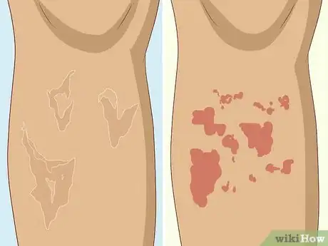 Image titled Soothe Itchy Legs Step 2