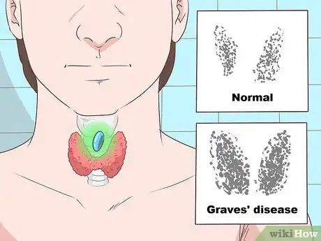 Image titled Recognize the Signs of Graves' Disease Step 18