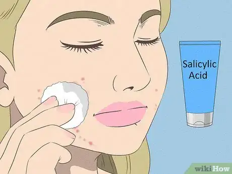 Image titled Get Rid of Acne if You Have Fair Skin Step 4