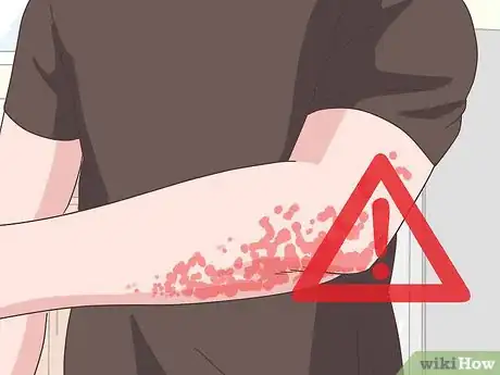 Image titled Treat Both Psoriatic Arthritis and Psoriasis Step 17