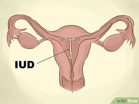 Image titled Switch Birth Control Methods Step 19