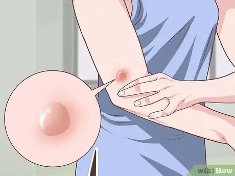 Image titled Handle a Rheumatoid Arthritis Skin Problem Step 1