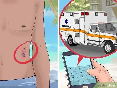 Image titled Identify and Treat Injuries From Stingrays and Sea Urchins Step 13