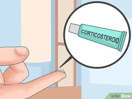 Image titled Soothe Psoriasis Flares Step 2