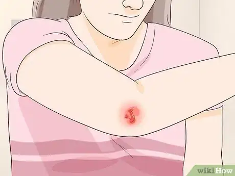 Image titled Recover from Zinc Deficiency Step 16