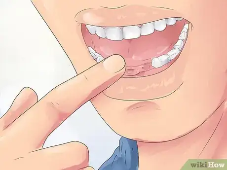 Image titled Handle Tooth Loss Step 7