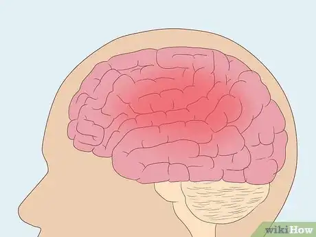 Image titled Treat Hypersomnia Step 6