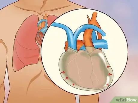 Image titled Treat Obstructive Shock Step 4