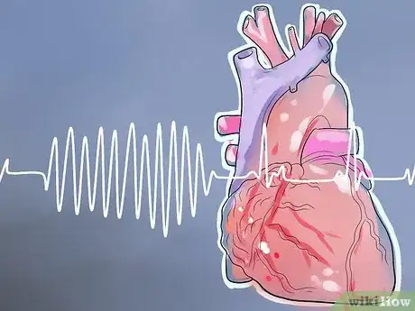 Image titled Identify Heart Arrhythmias Step 1