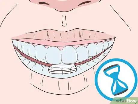 Image titled Cope with Teeth Whitening Sensitivity Step 7