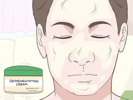 Image titled Prevent Vitiligo from Getting Worse Step 9