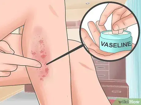Image titled Soothe Psoriasis Flares Step 1