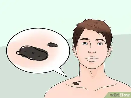Image titled Examine a Mole Step 6