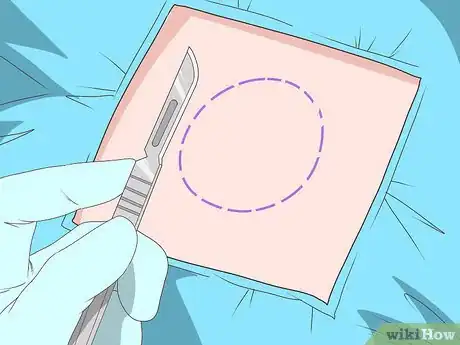 Image titled Diagnose Sarcoma Step 16