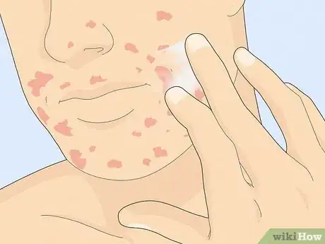 Image titled Wear Makeup when You Have Eczema Step 2