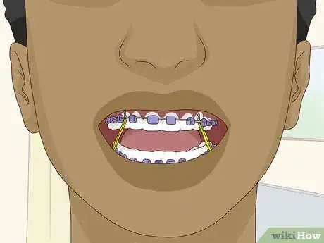 Image titled Wear Braces With Confidence and Style Step 1