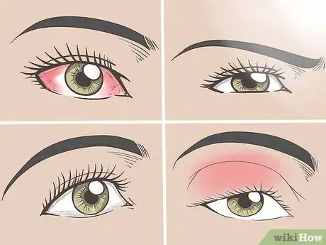 Image titled Treat Eye Sunburn Step 1