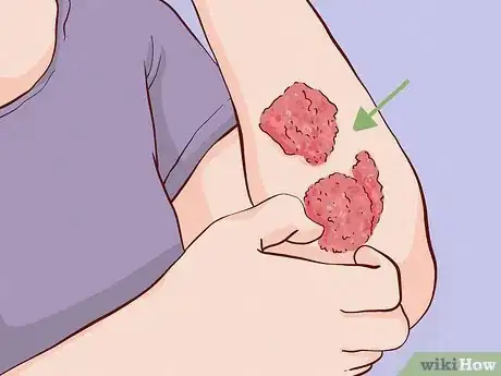 Image titled What Causes Skin to Be Sensitive Step 5