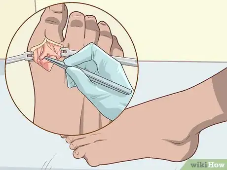 Image titled Handle a Rheumatoid Arthritis Skin Problem Step 9