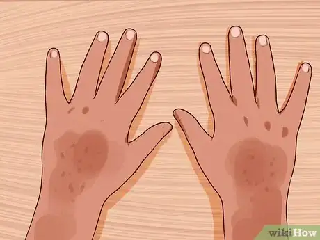 Image titled Determine the Side Effects of an MMR Vaccination Step 8