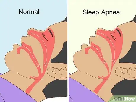 Image titled Treat Hypersomnia Step 5