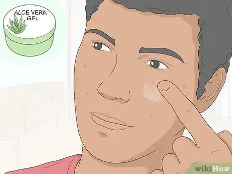 Image titled Get Rid of Acne Scars at Home Without Chemicals Step 2