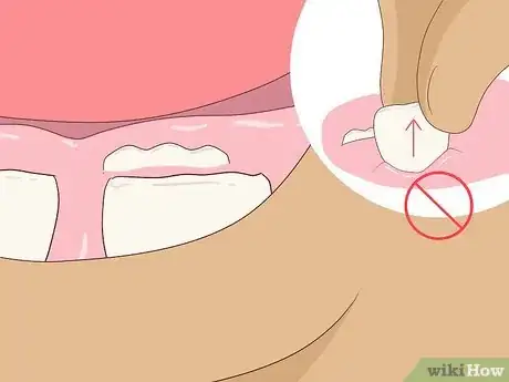 Image titled Pull a Loose Tooth at Home Step 15