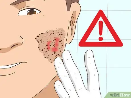Image titled Remove an Ingrown Hair Step 5