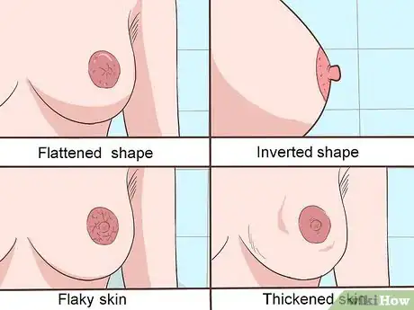 Image titled Treat Breast and Extramammary Paget's Disease Step 11