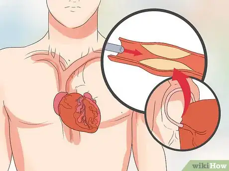 Image titled Spot Symptoms of Coronary Heart Disease Step 20
