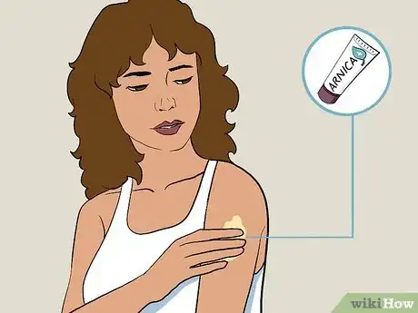 Image titled Care for a Bruise Naturally Step 1