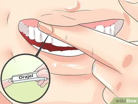 Image titled Deal With a Sore Tooth Step 5