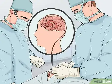 Image titled Recognize and Treat Lymphocytic Choriomeningitis (LCM) Step 14