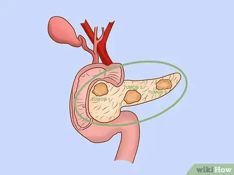 Image titled Treat Pancreatic Cancer Step 5