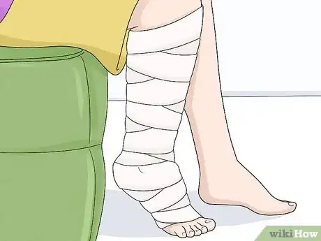 Image titled Identify Lymphedema Step 14