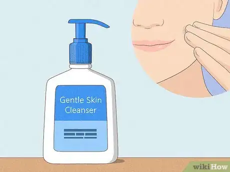 Image titled Clean Your Face to Prevent Pimples Step 3