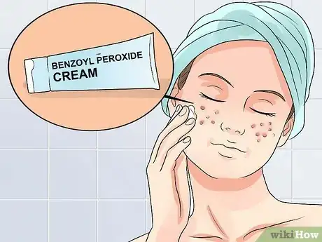 Image titled Clear Mild Acne Fast Step 1